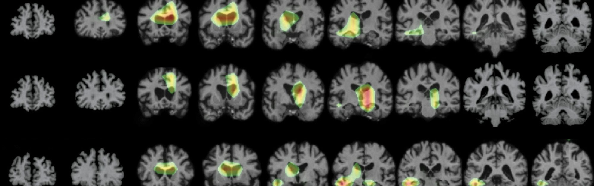 MRI imaging of brains.